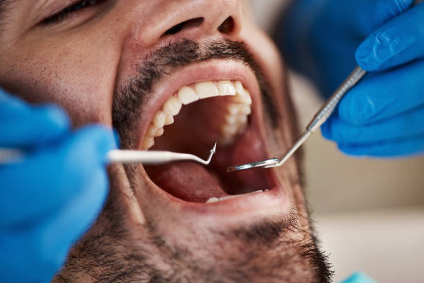 Best Emergency Tooth Extraction in Bertram, TX