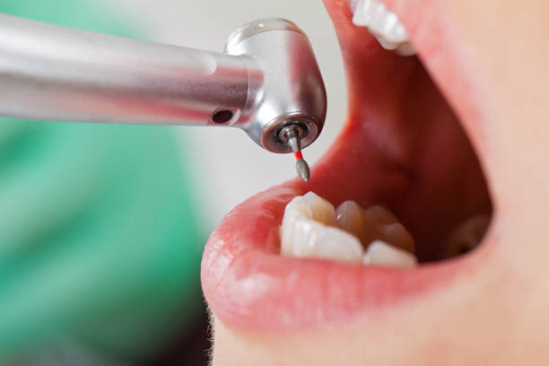 Best Emergency Tooth Extraction in Bertram, TX